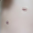 (주)아워홈 목동제일여성병원점 | 남편의 담낭 절제술 4화 - 이대목동병원에서 수술 후 회복 기간, 복강경 흉터 +전체 회차 링크