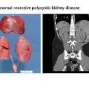 Autosomal recessive polycystic kidney disease 이미지