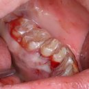 가야치과의원 | [공지] 이 뽑으러 대학병원 가야한다구요?! 중학생 치과치료 후기, 이아소치과