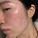 유어의원 | 그토록 달고살았던 편평사마귀 제거 후기 + 알고보니 편사가 아니다 !?