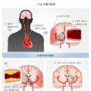 [통합간편]뇌졸중 진단비 특별약관과 [통합간편](체증형,완납시2배)뇌졸중 진단비 특별약관의 비교 이미지