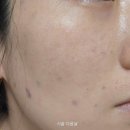 미라콜로 | 신사역피부과 속건조콜라겐재생 콜라겐주사 미라콜 후기 피부 촉촉