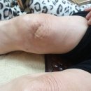 11.10 골다공증/ 당뇨/ 도포방법 이미지