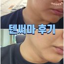 과천청사온누리약국 | 과천 정부과천청사역 피부과 텐써마 리프팅 후기