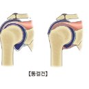 어제 오후 오십견 이미지