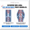 하지정맥류초기치료, 치료 결정 전에 반드시 확인해야 할 것!! 이미지