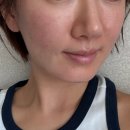 이주 | 강남피부과 쥬브아셀효과 이주차 경과 후기