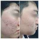 인제피부관리 서율가에스테텍 닥터아크네제로 관리 후기