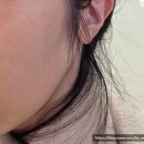 여의도약국 | [후기] 내돈내산 흑자 제거 리팟레이저 3개월 후기 @ 여의도 피부과