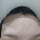 금오동피부관리 예오미오 고퀄리티 여드름 케어 받은 후기