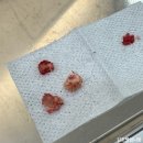 가이드본치과의원 | 인천 부평 사랑니 치과 추천｜신경 가까운 매복사랑니 당일 발치 후기