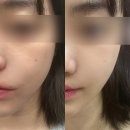 브리앙떼스킨케어 | 삼성역 피부과 모공케어 5세대 ECM 아디떼 스킨부스터 후기