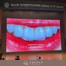 뉴정석치과기공소 | 최소삭제 라미네이트 얼마나 삭제할지 어떻게 결정할까 - 접착치의학회 춘계학술대회 후기(4)