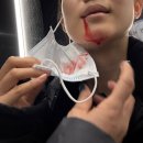 크라운복싱 | 어금니 크라운 재신경치료 후 발치 통증 응급실