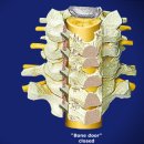 Cervical Stenosis에 대한 수술 방법 중 하나입니다..참고하세여! 이미지