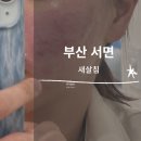 ㅣ부산 새살침 5,6회차 후기, 통증, 가격ㅣ여드름 흉터 관리ㅣ