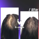 디비전 스칼프 | 광교동탄 20대여자탈모! 헤어컨실러보다 편한 커버방법
