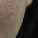 동탄리뉴본한의원 | 여드름흉터 치료 3회 후기+모공관리,부산흉터치료한의원(feat.새살침,리뉴테라피)사진+말 많음 주의