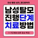 정다운약국 | 안산 남성탈모, 단계별 맞춤 관리로 탈모 진행 늦추는 방법