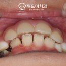 맹출 자리가 없는 "영구치 송곳니", 내 자리 어딨어?( WITH ME 평택 치과 )