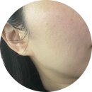 클리어짐 | 미작뷰티 클리어 스팟프로 3~5회차 후기｜기미 옅어짐 실감! 피부톤이 밝아져