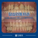다서울치과의원 | 답십리동치과, 사용 중이던 틀니가 불편해요