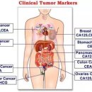 암 표지자 검사의 문제점; 특히 CA-19-9에 관하여 이미지