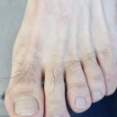 케어메디칼 | 두꺼운 변색발톱 관리 때문에 방문한 청주문제성발톱 업체 메디컬풋케어 첫 관리 후기!