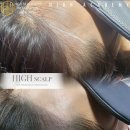 하이스칼프 이미지