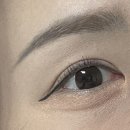 수한약국 | 쌍수 재수술 1달 한달 후기 + 비교사진