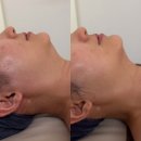 정아 | 창원피부관리 고객 맞춤 하이푸리프팅 잘하는곳 정아하다에스테틱 후기