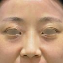 닥터뷰주 | 대구 울트라콜 후기, 눈밑이 검게 변한 여성 환자