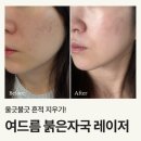 레이저 | 마포공덕 퍼스트피부과 전문의 여드름/붉은자국 레이저 후기 (전후 변화 기록)