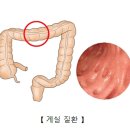 게실 질환(Diverticular disease) 이미지