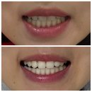 밝은이치과기공소 | 구리 인창동 치과, 치아미백 솔직 후기 2회차 만에 밝은 이 득템했어요:)