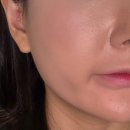 쿨타임 | 청담동피부과 / 다운타임없는 리프팅 쿨소닉 찐 후기