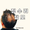 자연과 기술(주) | 부산두피문신 자연스러운 정수리 탈모 두피문신 후기와 가격 비용, 부작용
