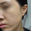 한불스킨케어 | 강릉 피부관리샵 온결스킨 – 하이드라 4HA 단기간 집중케어 후기