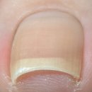 별내동44통(위스테이) | 별내 내성발톱 1년 관리 후기 남양주 네일지몽