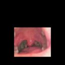 다함이비인후과의원 | #편도선 제거 #비염 수술 후기(사진 극혐 주의)-2년차