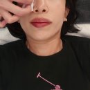 이랑고랑 | 강남피부과 : 다크서클 시술 루엘프팅 눈밑지방재배치레이저 솔직 후기