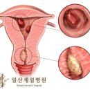 자궁 내경관 용종[endocervical polyp] 이미지