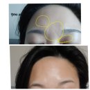 대지한의원 | 재생테이프도 필요없고 회복도 넘나 빠른 서면 얼굴 편평사마귀 제거 후기