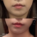 삼성하이퍼 | [명동역피부과] 하이퍼티타늄 리프팅 명동역피부과전문의 솔직후기 _ 통증/전후비교