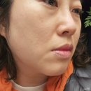 얼굴 피부탄력 레이저 엠페이스 관리 효과