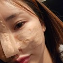 11545-03-29-11 | 강남 디에이 병원 자려한코 첫 코수술 연골과 기증늑 후기 [사진 극혐주의🚫]