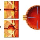 녹내장이란 이미지