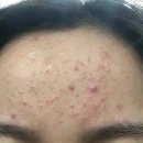약국 재생연고 여드름에 사용해본 후기