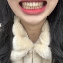 에이라인치과병원 | [일상] 청주 에이라인치과 교정 후기