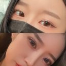 여우야PC | 20대 여자 쌍커풀 성형수술 후기 !! 자연유착 쌍커풀